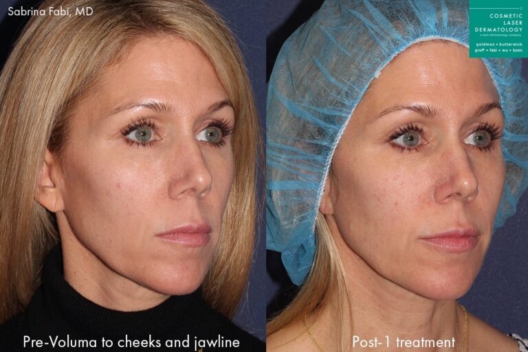 Before and after oblique image of Voluma treatment on a female's cheeks and jawline performed by Dr. Fabi at our San Diego medical clinic