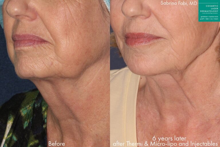 Before and after oblique image of Ultherapy and injectables on a female's lower face and neck performed by Dr. Fabi at our San Diego medical spa