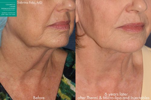 Before and after Ultherapy and injectables on a female's lower face and neck performed by Dr. Fabi at our San Diego medical spa