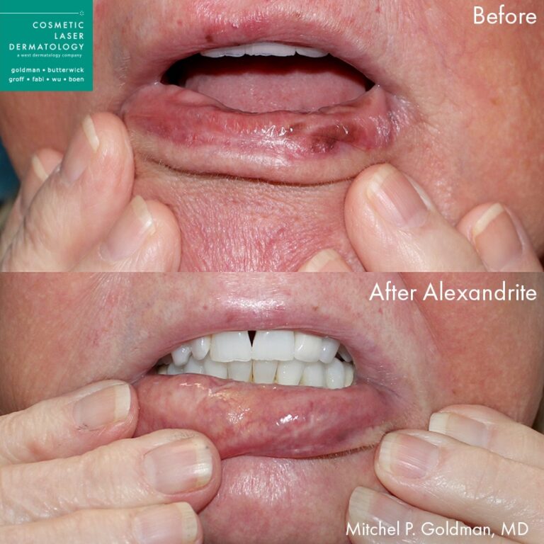 Before and after front image of Alexandrite laser treatment on a female's lips performed by Dr. Goldman at our San Diego medical spa