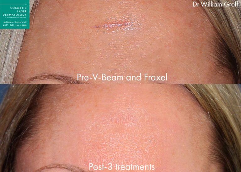 Before and after front image of Vbeam and Fraxel on a females's forehead performed by Dr. Groff at our San Diego medical spa.