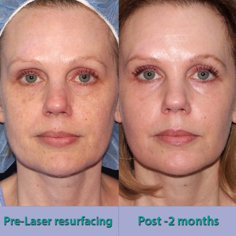 Before and after front image of laser resurfacing treatment on a female's face performed by Dr. Groff at our San Diego medical spa