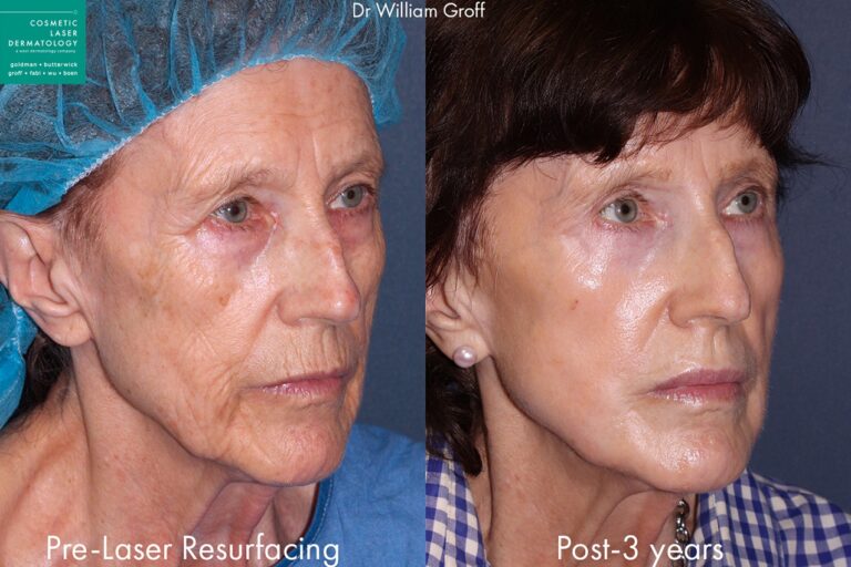 Before and after oblique image of laser treatment on a female's face performed by Dr. Groff at our San Diego medical spa