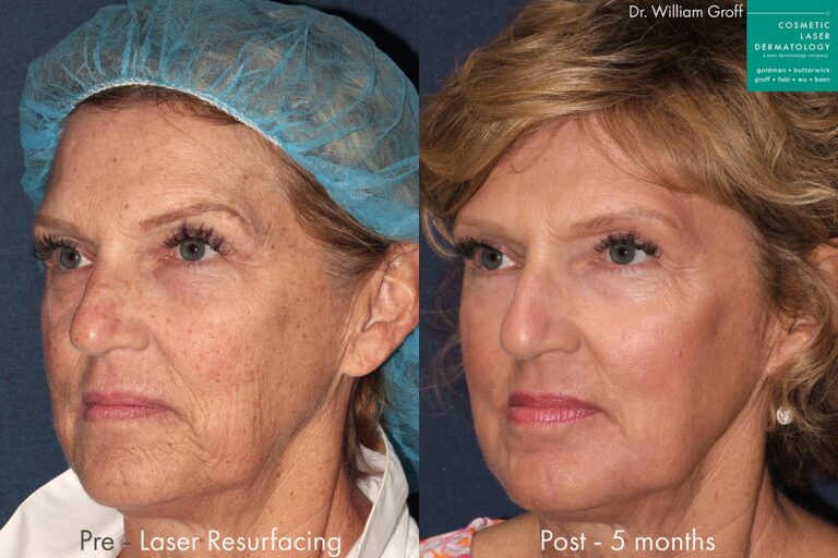 Before and after oblique image of laser treatment on a female's face performed by Dr. Groff at our San Diego medical clinic