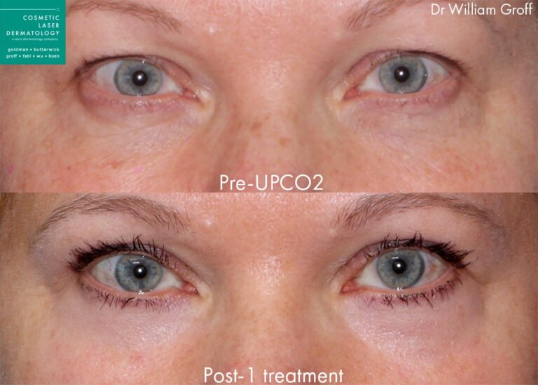 Before and after frontal image of UPCO2 on a female's eyelids performed by Dr. Groff at our San Diego medical spa.