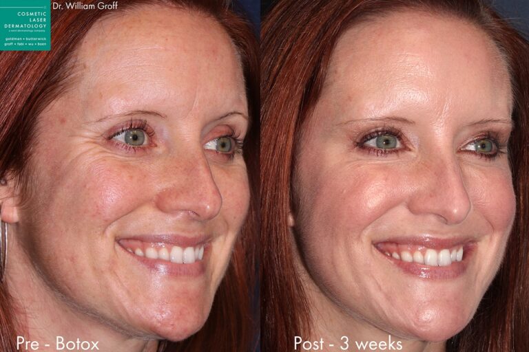 Before and after oblique image of Botox treatment on a female's eyes performed by Dr. Groff at our San Diego medical spa