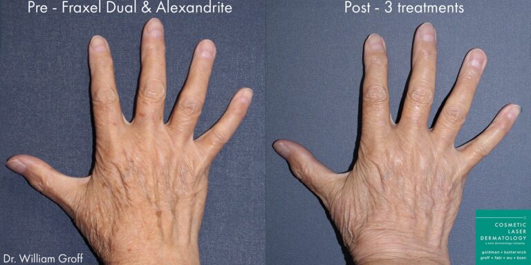 Before and after front image of Fraxel treatment on a female's hands performed by Dr. Groff at our San Diego medical spa