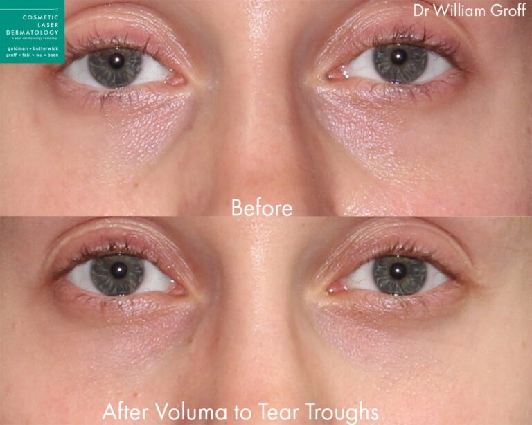 Before and after front image of Voluma injections on a female's tear trough performed by Dr. Groff at our San Diego medical spa.