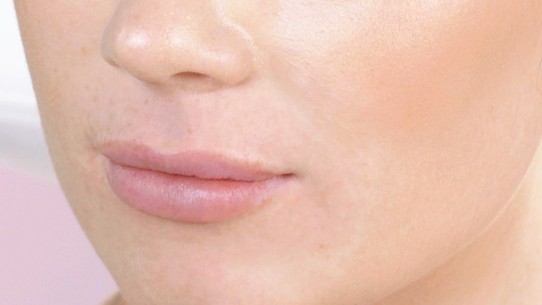 Closeup photo of lip filler results in San DIego