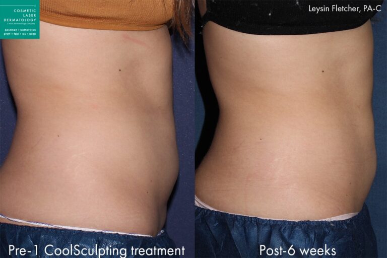 Before and after side image of CoolSculpting treatment on a female's abdomen performed by Leysin Fletcher, PA-C at our San Diego medical clinic