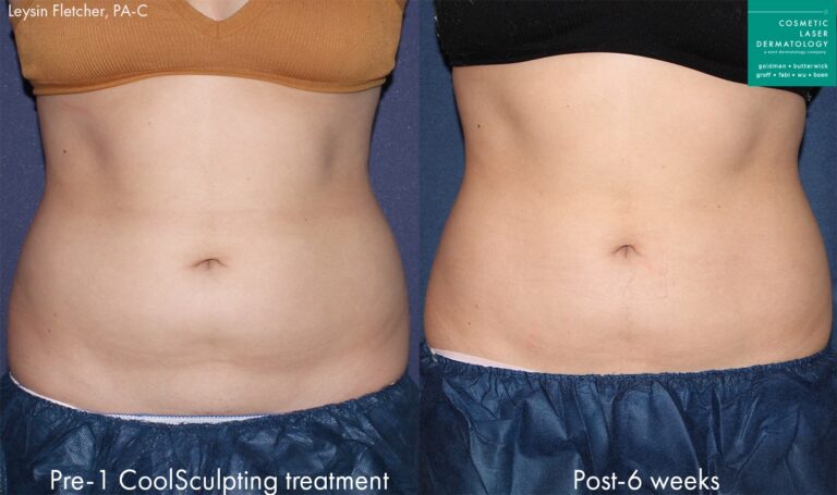 Before and after front image of CoolSculpting treatment on a female's abdomen performed by Leysin Fletcher, PA-C at our San Diego medical clinic