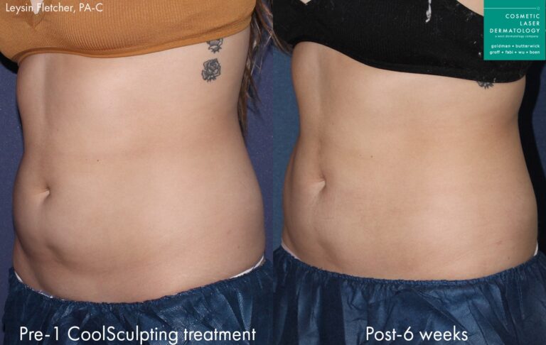 Before and after oblique image of CoolSculpting treatment on a female's abdomen performed by Leysin Fletcher, PA-C at our San Diego medical clinic