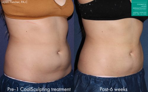 1 CoolSculpting Medical Spa, San Diego, CA