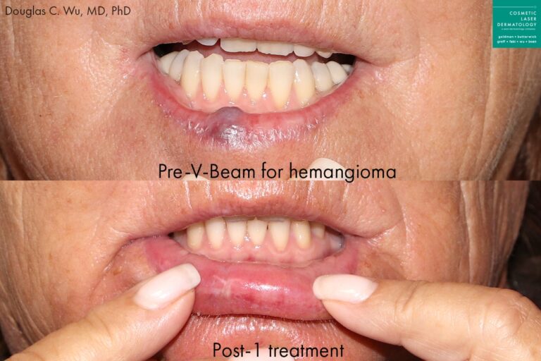 Before and after front image of Vbeam treatment on a female's lip performed by Dr. Wu at our San Diego medical spa