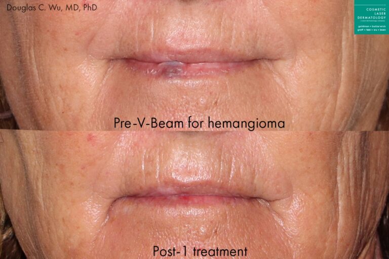 Before and after front image of Vbeam treatment on a female's lip performed by Dr. Wu at our San Diego medical spa