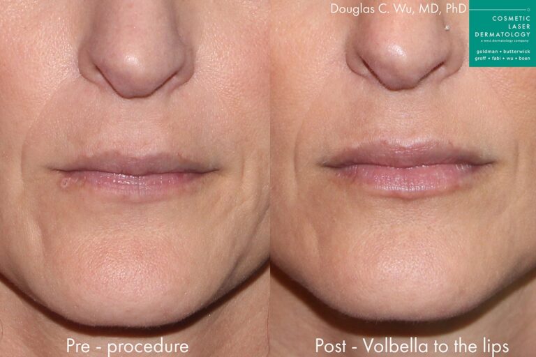 Before and after front image of Volbella treatment on a female's lips performed by Dr. Wu at our San Diego medical spa