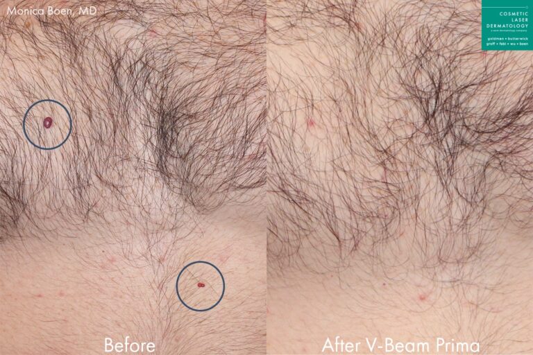 Before and after front image of Vbeam treatment on a male's chest performed by Dr. Boen at our San Diego medical spa