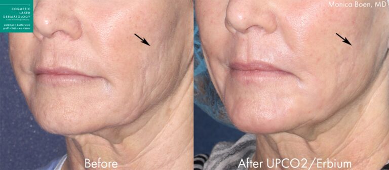 Before and after oblique image of UPCO2 laser treatment on a female's cheeks performed by Dr. Boen at our San Diego medical spa