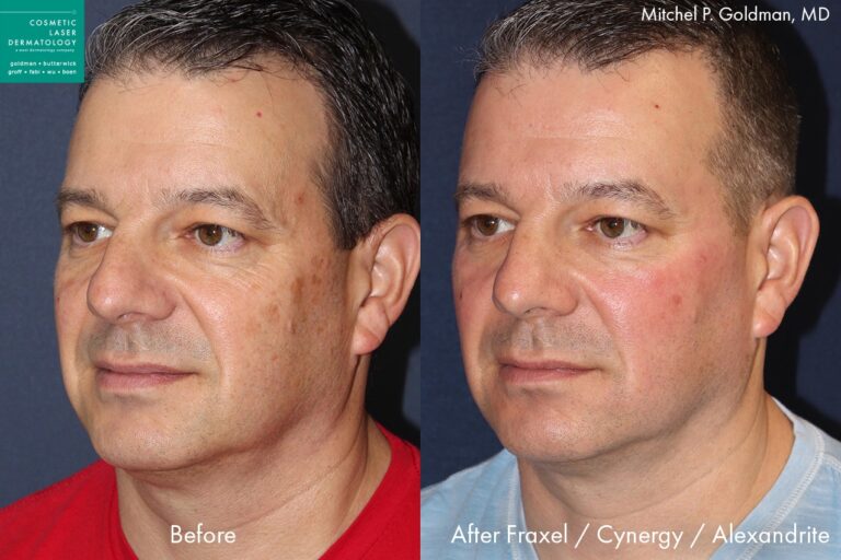 Before and after oblique image of Fraxel , Alexandrite, and Cynergy laser treatment on a male's cheeks performed by Dr. Goldman at our San Diego medical spa