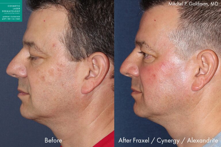 Before and after side image of Fraxel, Cynergy and Alexandrite laser treatment on a male's face performed by Dr. Goldman at our San Diego med spa
