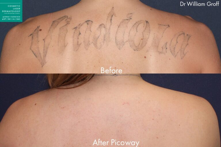 Before and after back image of PicoWay laser tattoo removal on a female's back performed by Dr. Groff at our San Diego medical clinic