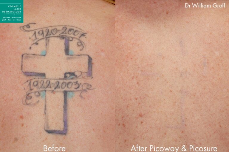 Before and after back image of PicoWay and PicoSure laser tattoo removal on a female's back performed by Dr. Groff at our San Diego medical spa