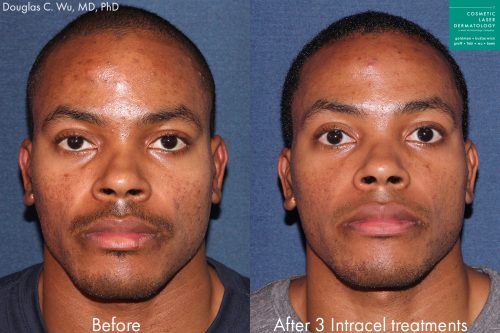 Before and after front image of Intracel treatment on a male's cheeks performed by Dr. Wu at our San Diego medical spa