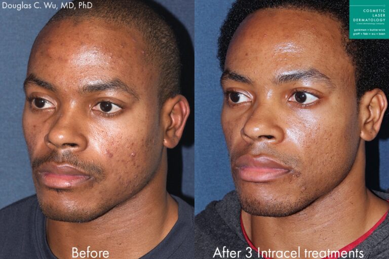 Before and after oblique image of Intracel treatment on a male's cheeks performed by Dr. Wu at our San Diego med spa