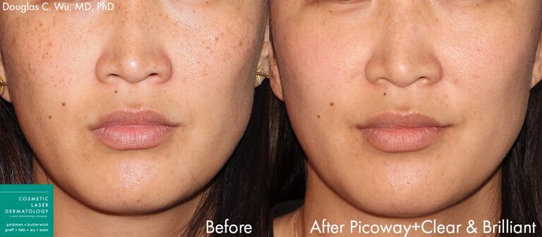 Before and after front image of PicoWay laser treatment on a female's cheeks performed by Dr. Wu at our San Diego medical spa