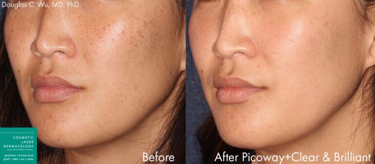 Before and after front image of PicoWay laser treatment on a female's cheeks performed by Dr. Wu at our San Diego medical spa