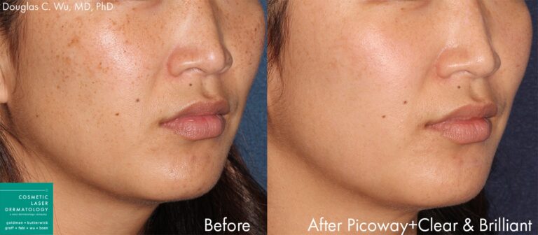 Before and after oblique image of PicoWay laser treatment on a female's cheeks performed by Dr. Wu at our San Diego medical clinic
