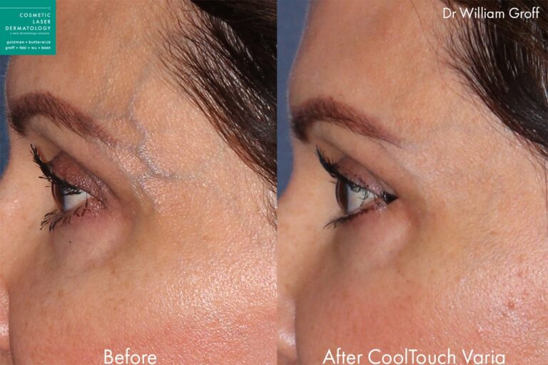 Before and after side image of CoolTouch Varia treatment on a female's temple veins performed by Dr. Groff at our San Diego medical clinic