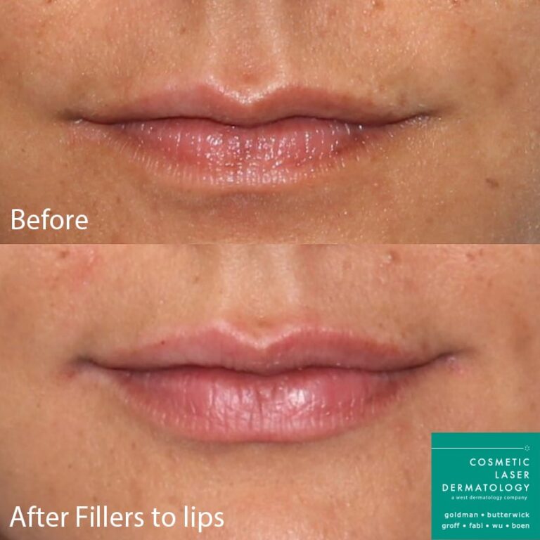 Before and after front image of filler treatment on a female's lips performed by Dr. Fabi at our San Diego medical spa
