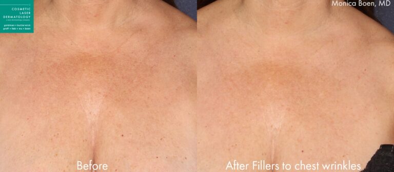 Before and after front image of an injectable filler treatment on a female's chest wrinkles performed by Dr. Boen at our San Diego medical spa