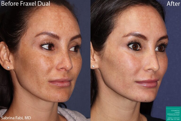 Before and after oblique image of Fraxel Dual laser treatment to treat sun damage on a female's face performed by Dr. Fabi at our San Diego med spa
