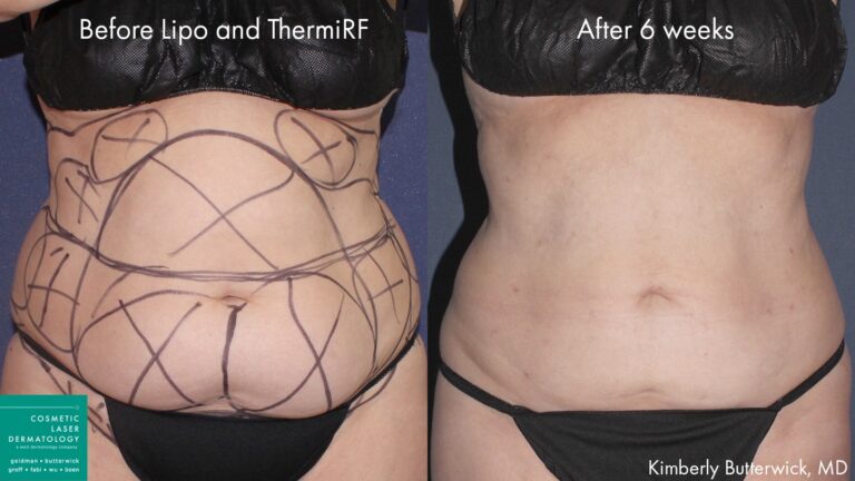 Before and after front image of a Liposculpture and ThermiRF treatment on a female's midsection performed by Dr. Butterwick at our San Diego medical spa