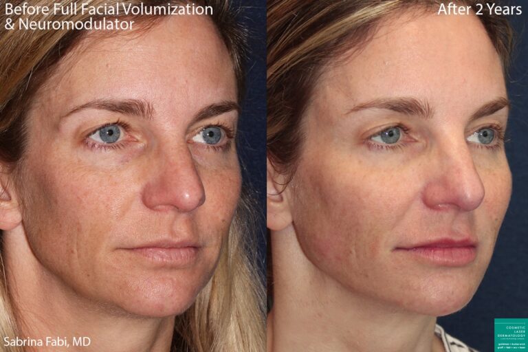 Before and after oblique image of dermal fillers and neuromodulator treatment on a female's face performed by Dr. Fabi at our San Diego medi spa