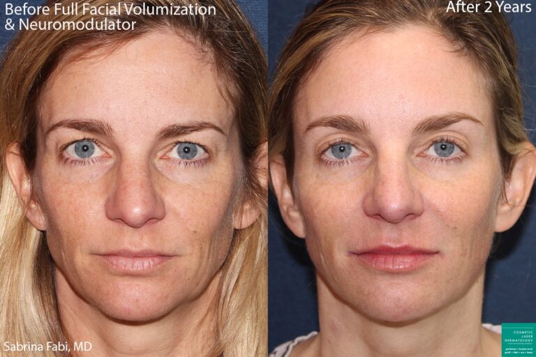 Before and after front image of filler and neurotoxin treatment for facial volumization on a female patient performed by Dr. Fabi at our San Diego medi spa