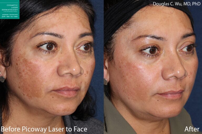 Before and after oblique image of PicoWay laser to treat sun damage on a female patient performed by Dr. Wu at our San Diego med spa
