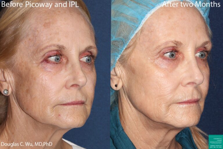 Before and after oblique image of PicoWay laser and IPL to rejuvenate the skin of a female patient performed by Dr. Wu at our San Diego med spa