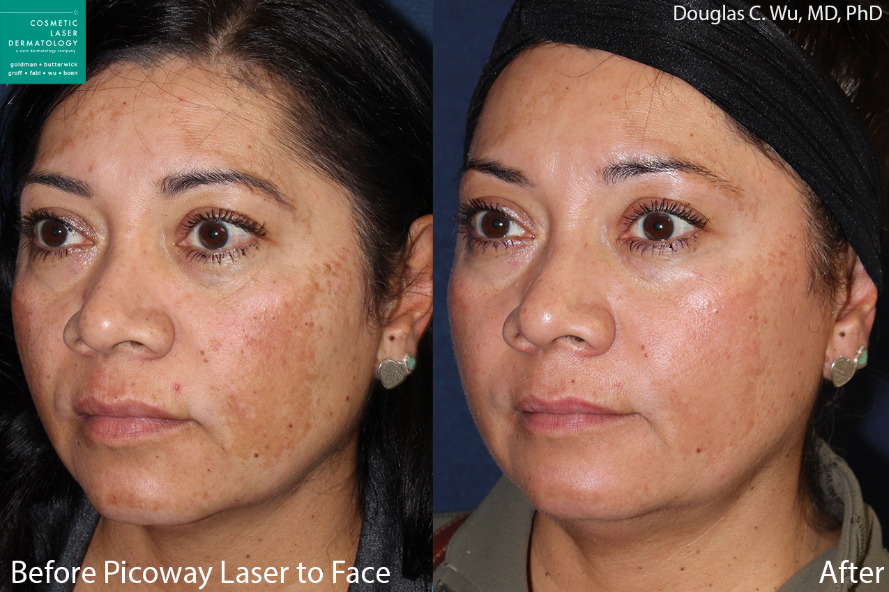 Before and after oblique image of PicoWay treatment for sun damage on a female's face performed by Dr. Wu at our San Diego medi spa