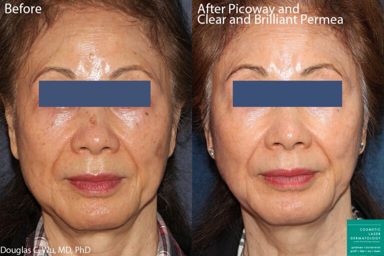 Before and after front image of a Clear+Brilliant and PicoWay to treat sun damage performed by Dr. Wu at our San Diego medical spa
