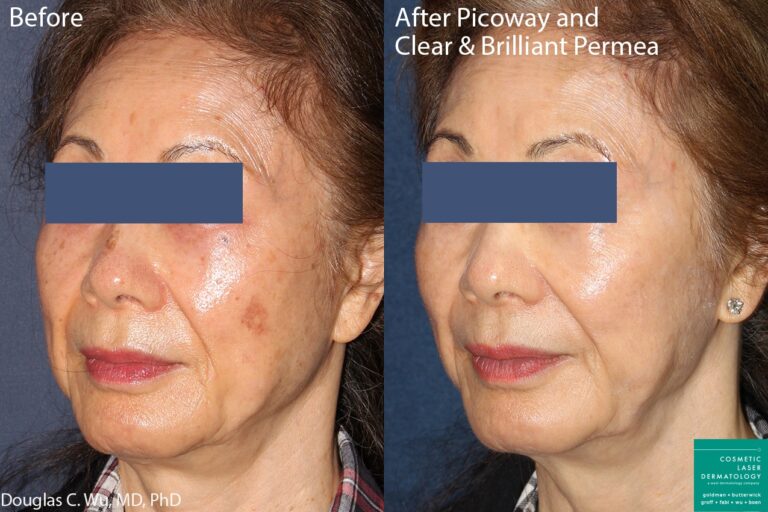 Before and after oblique image of Clear & Brilliant and PicoWay treatment on a female's face performed by Dr. Wu at our San Diego medi spa