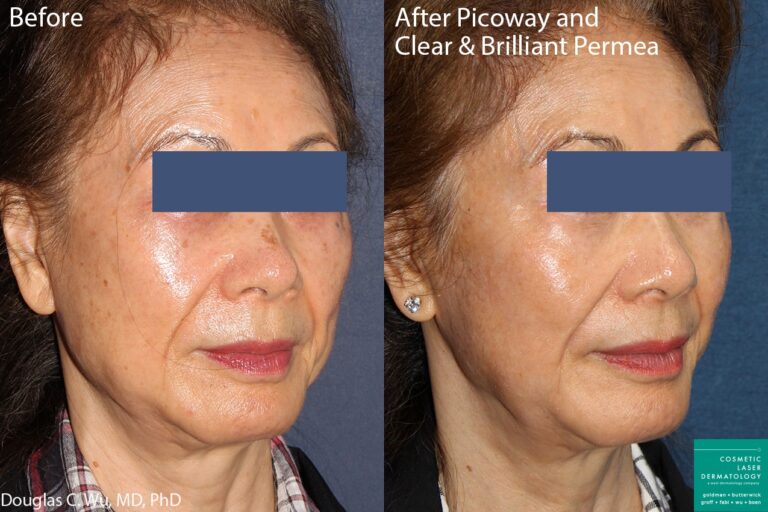 Before and after oblique image of Clear+Brilliant and PicoWay treatment on a female's face performed by Dr. Wu at our San Diego medi spa