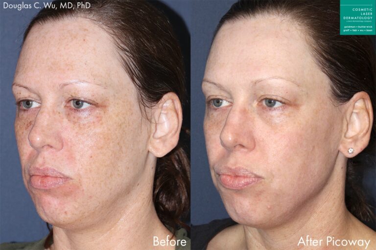 Before and after oblique image of PicoWay laser treatment on a female's face performed by Dr. Wu at our San Diego medi spa