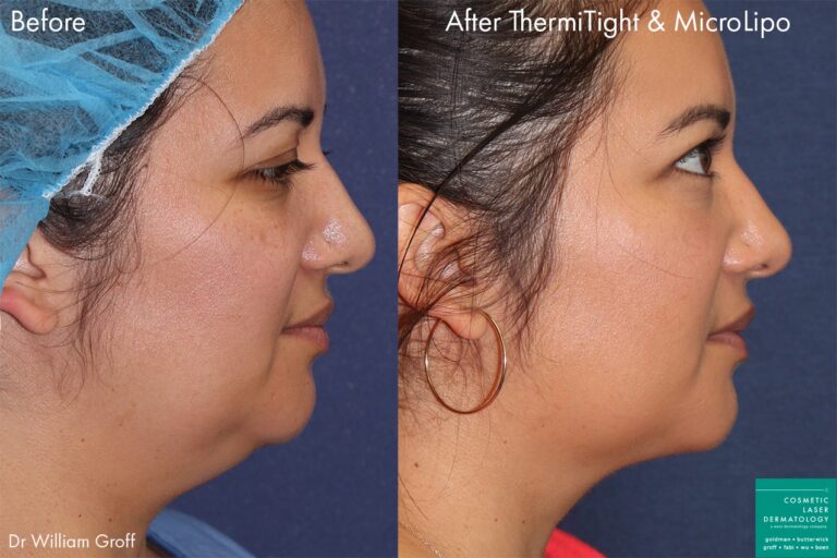 Before and after side image of a micro lipo and ThermiTight treatment on a female's submental fat performed by Dr. Groff at our San Diego medical spa