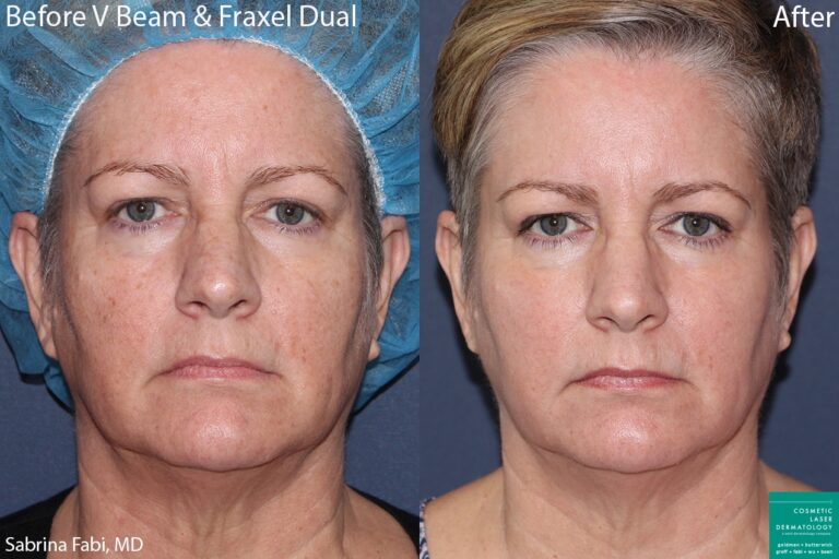 Before and after front image of Vbeam and Fraxel on a females's face performed by Dr. Fabi at our San Diego medical spa.