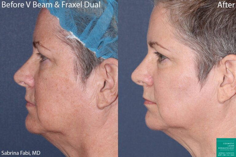 Before and after side image of Vbeam and Fraxel treatment on a female's skin performed by Dr. Fabi at our San Diego medical clinic
