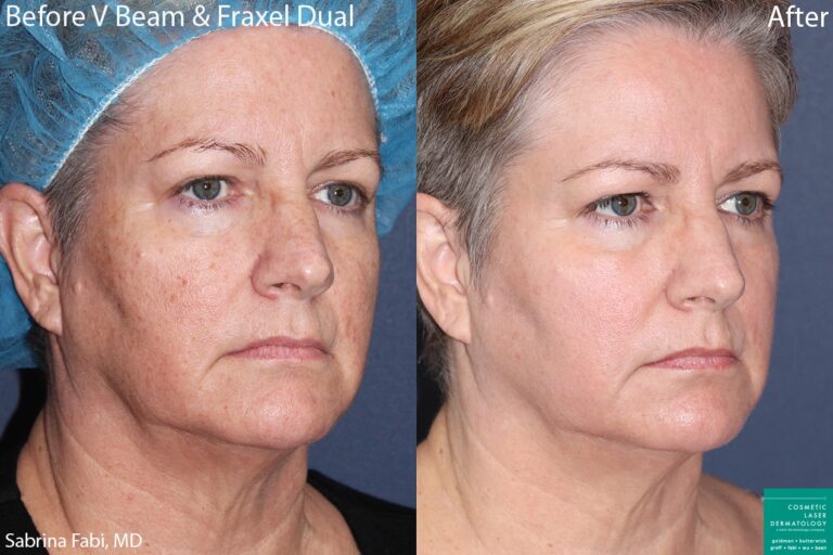 Before and after oblique image of Vbeam and Fraxel treatment on a female's skin performed by Dr. Fabi at our San Diego medical clinic