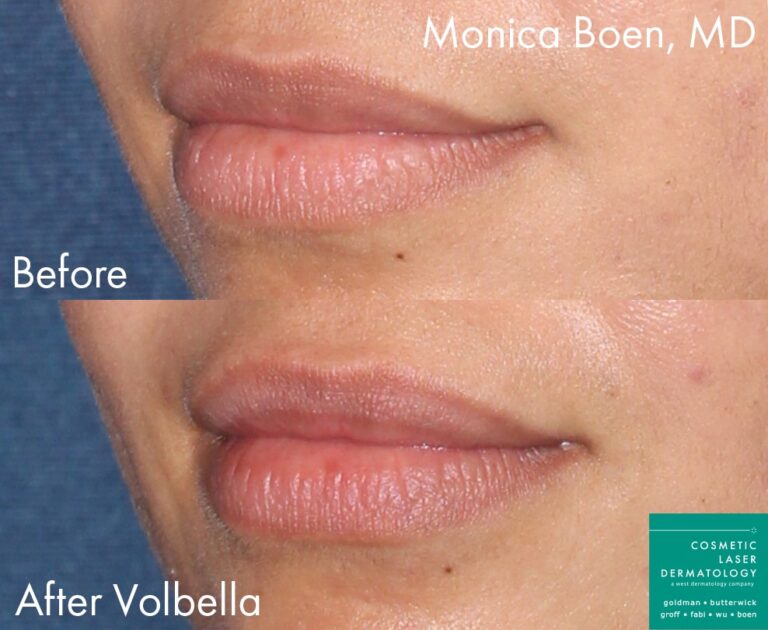 Before and after oblique image of Volbella treatment on a female's lips performed by Dr. Boen at our San Diego medical spa